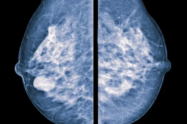 Breast cancer mammography image